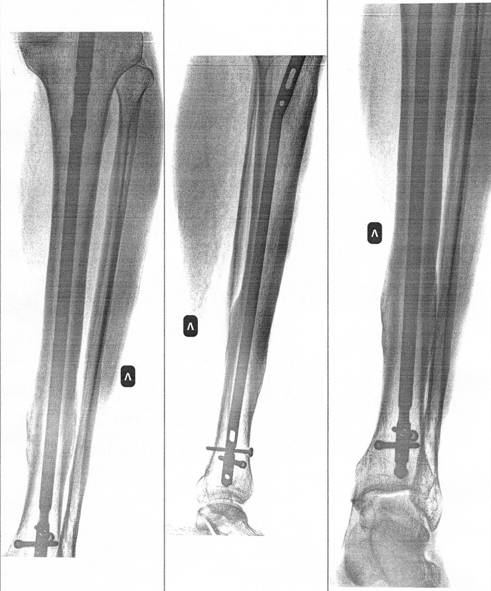 Рентген перед операцией. Видны места сросшихся переломов.