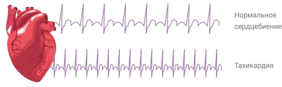 Учащённое сердцебиение без причины — возможные опасности