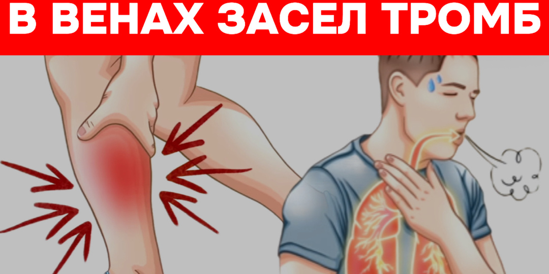Как понять, что в венах засел тромб? Главный симптом и что делать