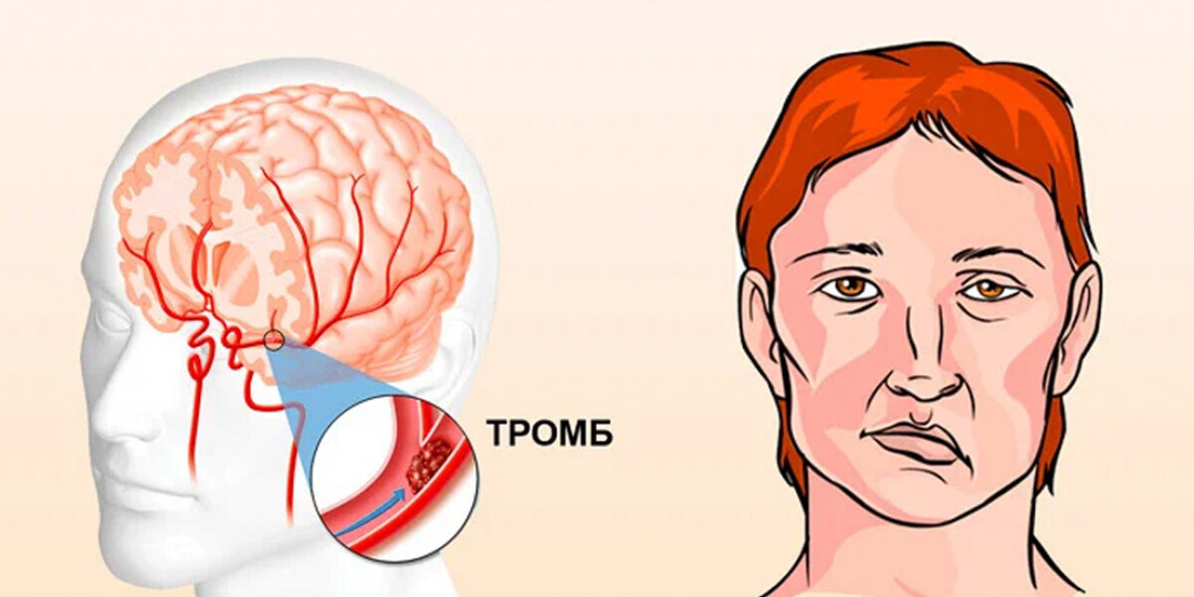 Инсульт может подкрасться незаметно: как не пропустить и чем он опасен
