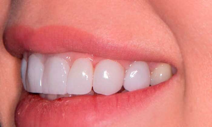 Фарфоровые виниры