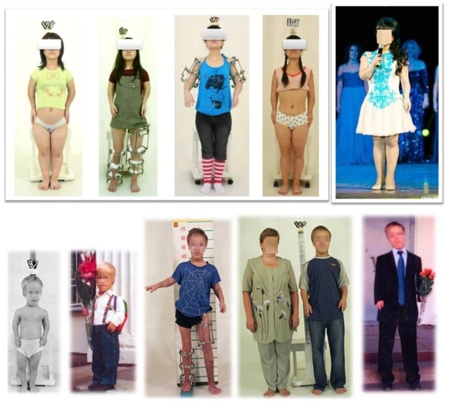    Девочка К. из Иванова (наверху) в 12 лет была ростом 99 сантимет- ров, к 18 годам её вытянули до 150. Мальчик А. из Москвы в 7 лет – 97 сантиметров, в 18 – 165. Фото: НМИЦ ТО имени академика Илизарова Минздрава РФ