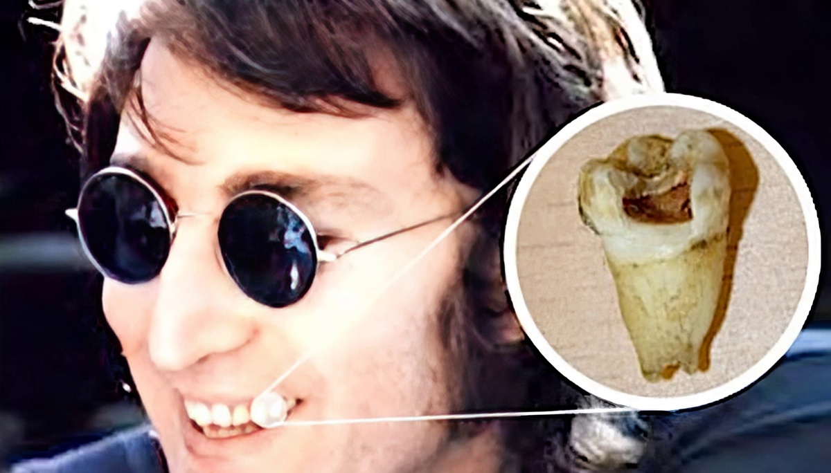 Зуб Леннона, проданный на аукционе в 2011 году