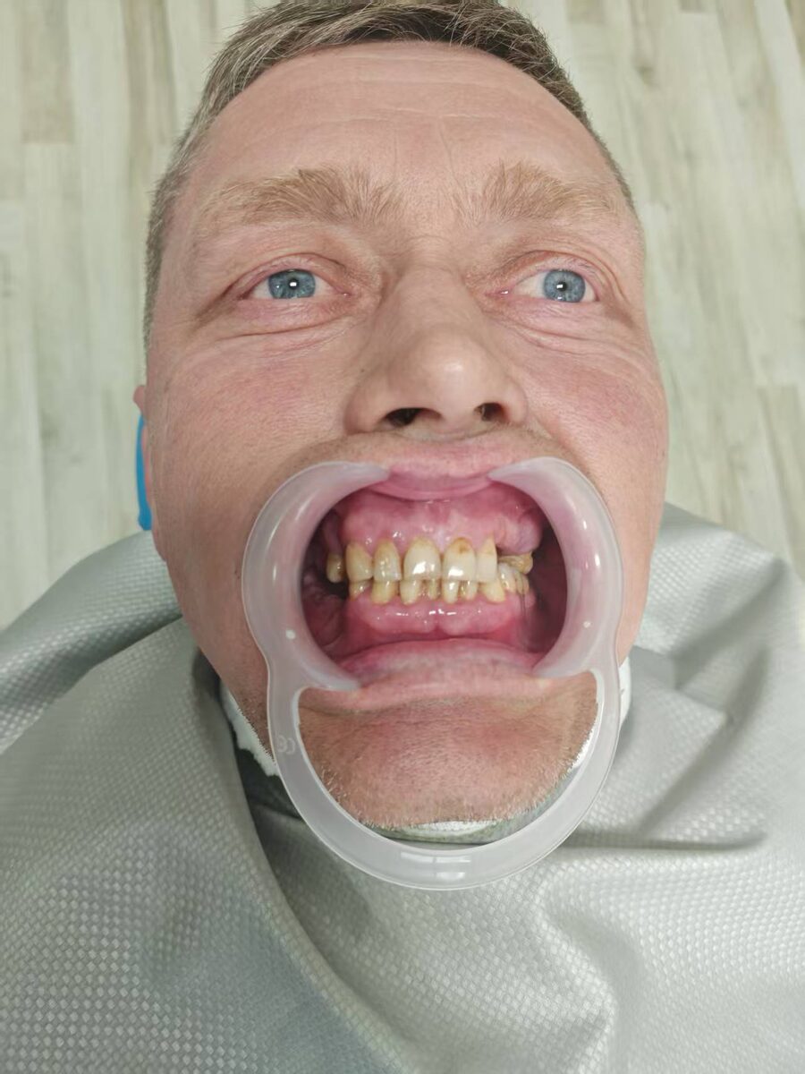 До протезирования