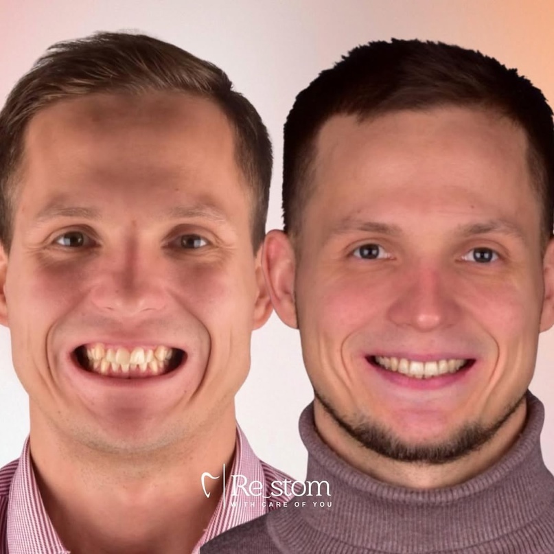 Лечение дистального прикуса и скученности зубов с помощью брекет-системы в клинике Рестом