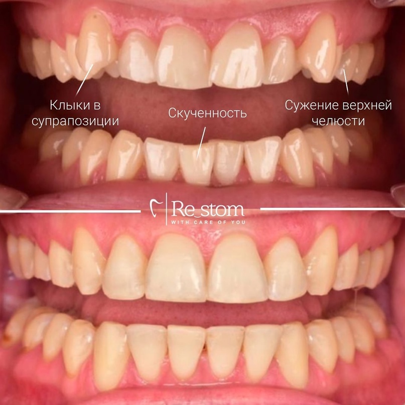 Лечение дистального прикуса и скученности зубов с помощью брекет-системы в клинике Рестом 