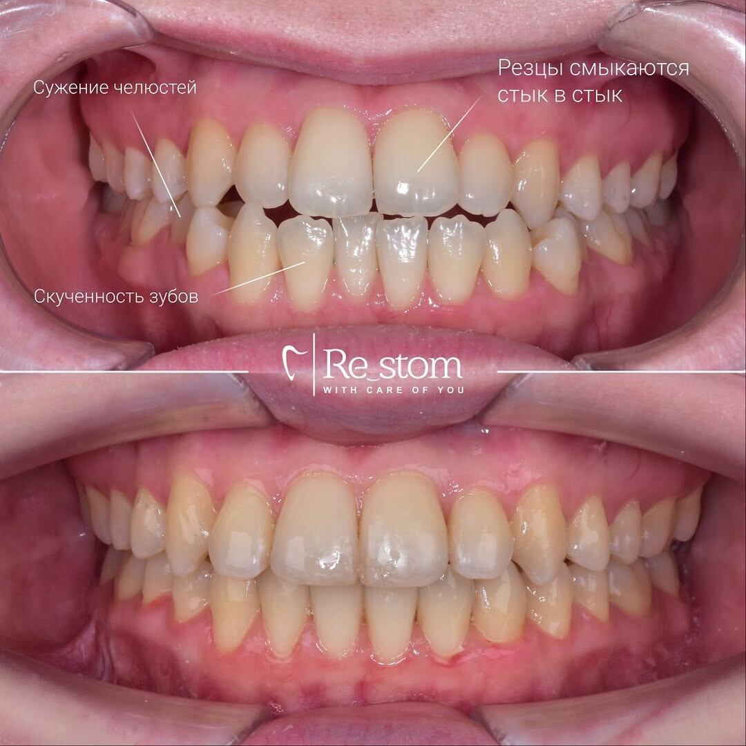 Лечение мезиального прикуса с помощью брекет-системы в клинике Рестом. стоматология СПб