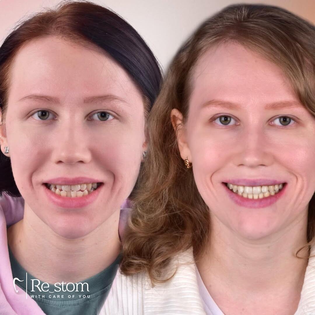 Лечение мезиального прикуса с помощью брекет-системы в клинике Рестом. стоматология СПб