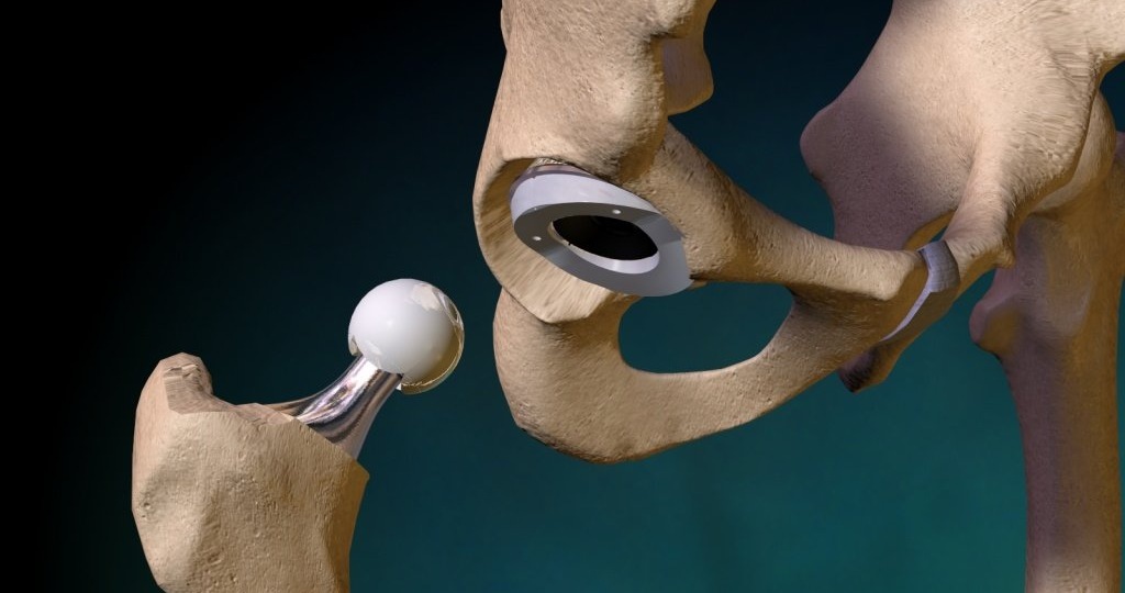 Реабилитация после эндопротезирования тазобедренного сустава с использованием электростимуляции