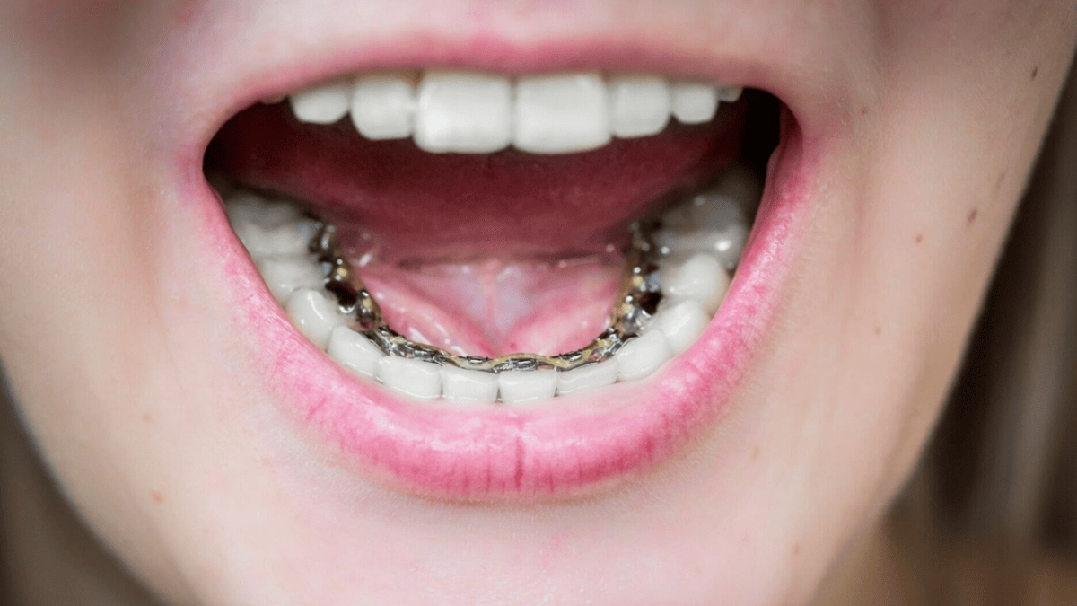 Лингвальные брекеты