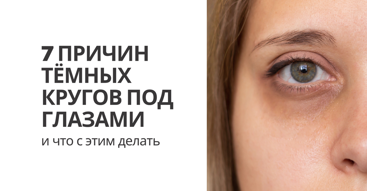7 причин тёмных кругов под глазами - и что с этим делать