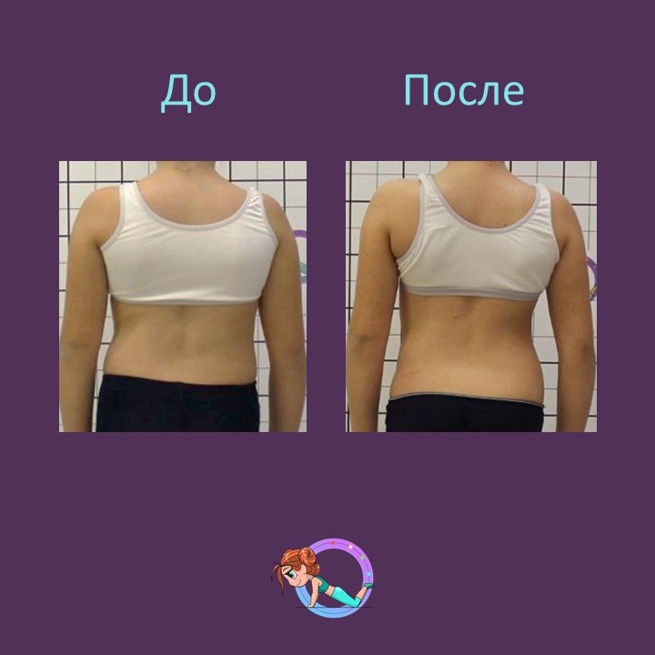 Пациентка К. 2012 г.р. обратилась на приём к врачу ортопеду к.м.н. 👨🏻‍⚕️ Шавырину И.А. с жалобами на деформацию позвоночника.
При осмотре поставлен диагноз: юношеский идиопатический 
сколиоз 2 степени (тест Риссера: 0-1).🩻
Было пройдено лечение: корсетотерапия по методу Шено и гимнастика Шрот.
На сегодняшний момент угол деформации уменьшен с ⚡️27 до 9⚡️ 
❗️Коррекция 65 % ❗️
Так же получен хороший косметический результат 👍🏼
#центрлечениясколиоза

