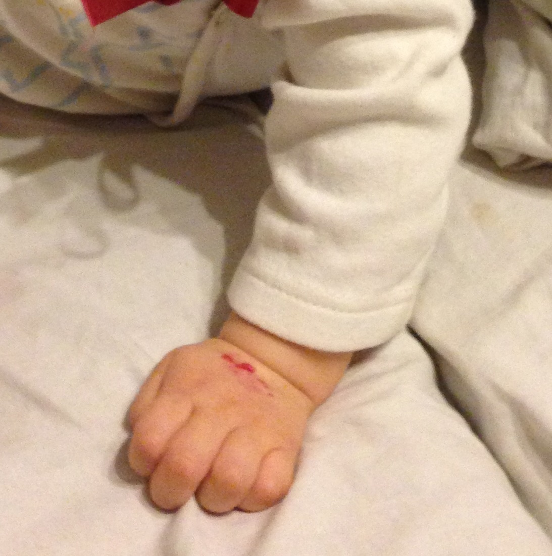 Гемангиома на руке моей 8-ми месячной дочери, здесь уже в стадии регресса. Сейчас она уже подросток, ни слединочки не осталось
