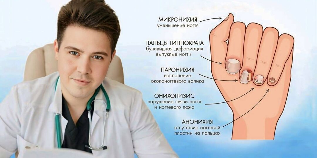 Как определить болезнь по ногтям: 14 изменений, которые не стоит игнорировать — от продольных полос до желтого оттенка