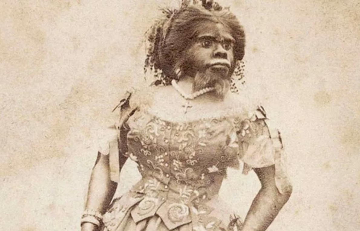 Дж.Пастрана страдала от разновидности наследственного гипертрихоза (терминальной его формы) в сочетании с выраженной гипертрофией десен. Данный признак часто ассоциирован именно с гипертрихозом