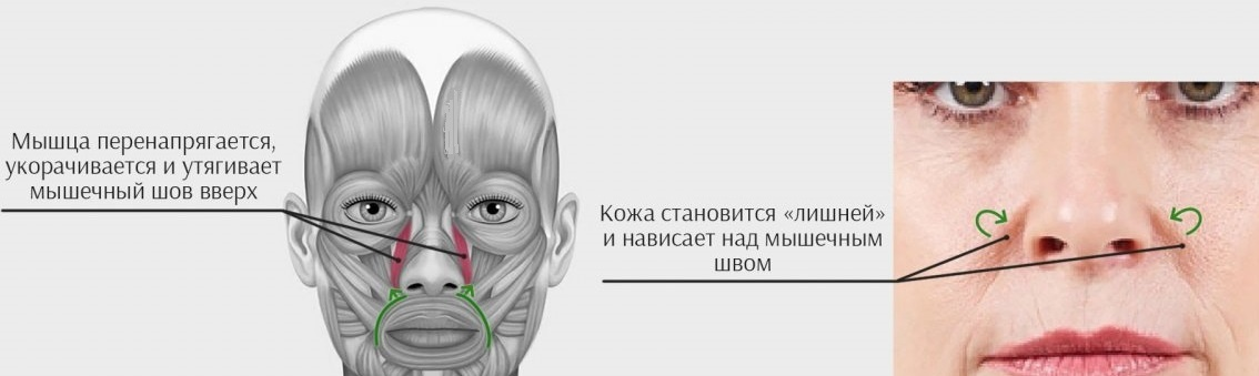Мышца поднимающая крыло носа и верхнюю губу - выделена красным на изображении
