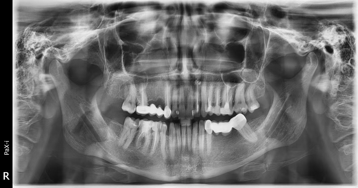Как выглядит ОПТГ снимок.