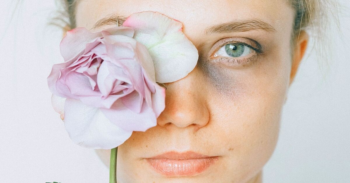 Как быстро убрать синяк?