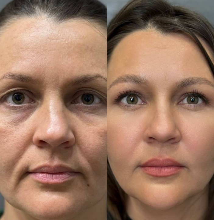 Объемное омоложение век фото до и после. Фото с сайта хирурга Д.Р. Гришкяна. Имеются противопоказания, требуется консультация специалиста