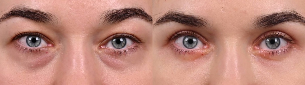 Объемное омоложение век фото до и после. Фото с сайта хирурга Д.Р. Гришкяна. Имеются противопоказания, требуется консультация специалиста