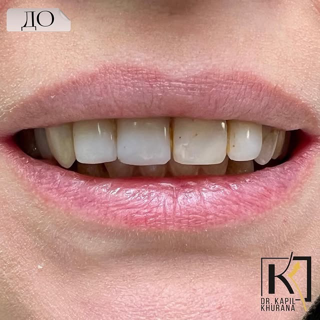 До установки керамических виниров