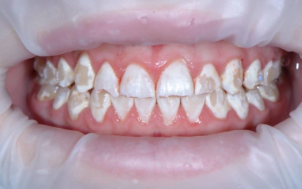 Длительное употребление кислых газированных напитков в элайнерах 