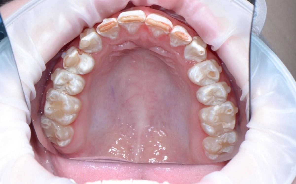 Эрозии - элайнеры + кислота