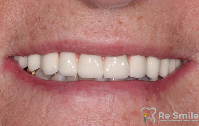 Пациентка обратилась в клинику с целью замены адаптационнного мостовидного протеза на верхней челюсти на постоянную конструкцию.

Проведено: протезирование верхней челюсти металлокерамическим мостовидным протезом.