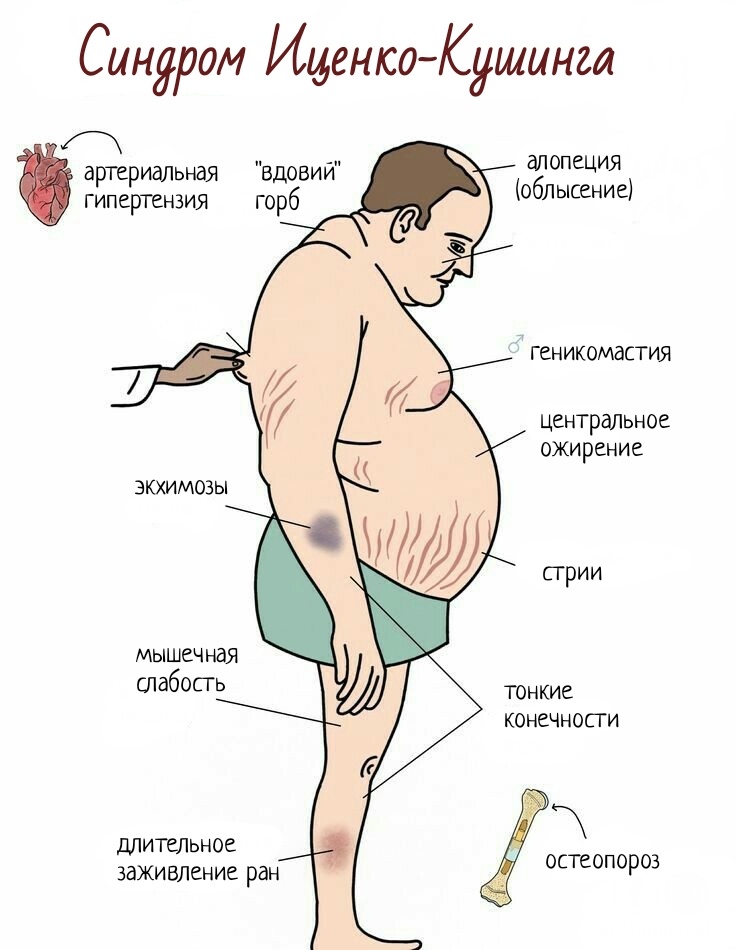Пример: ожирение при синдроме Иценко-Кушинга, данное заболевание диагностирует врач-эндокринолог, не занимайтесь самолечением!