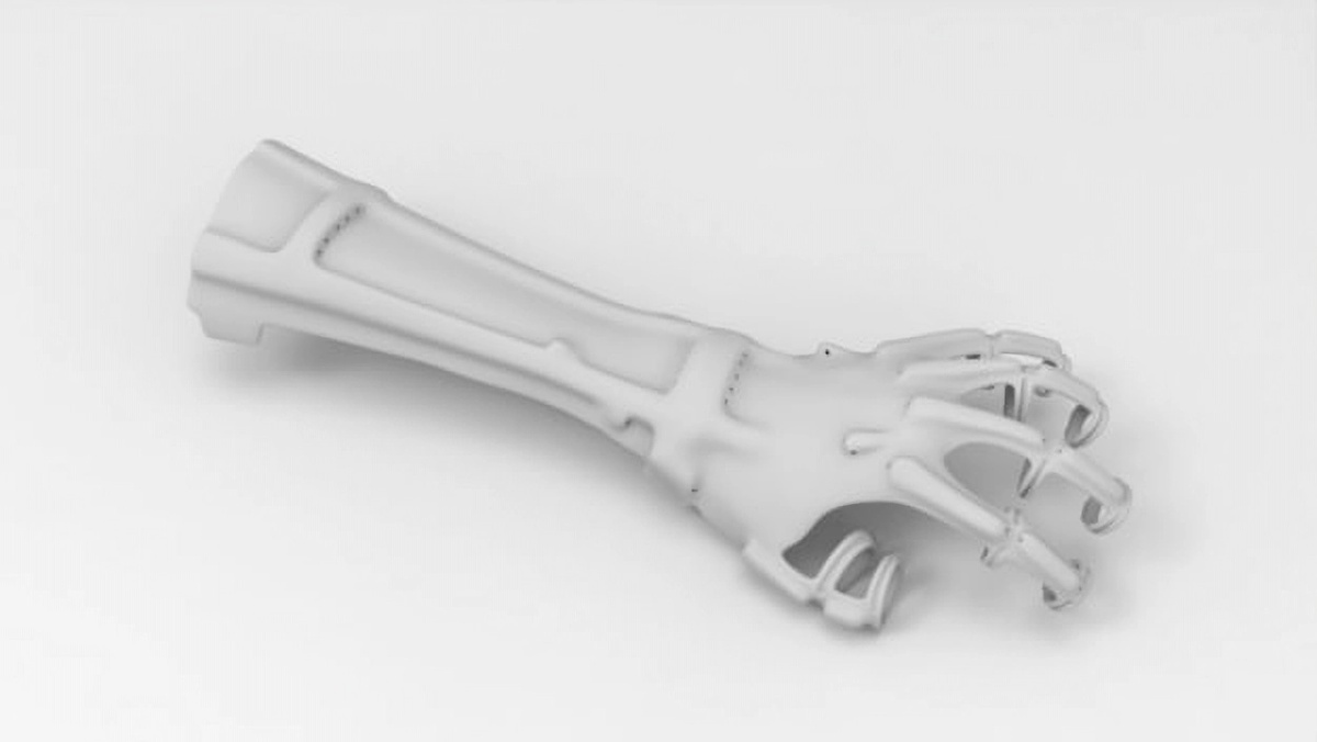   На фото представлен второй прототип ортеза. Для удобства пациентки внутренняя часть ладони оставили свободной. Отверстия нужны для натяжителей (натяжители фиксируются на фалангах пальцев и затем идут вдоль кисти, повторяя анатомию руки человека).