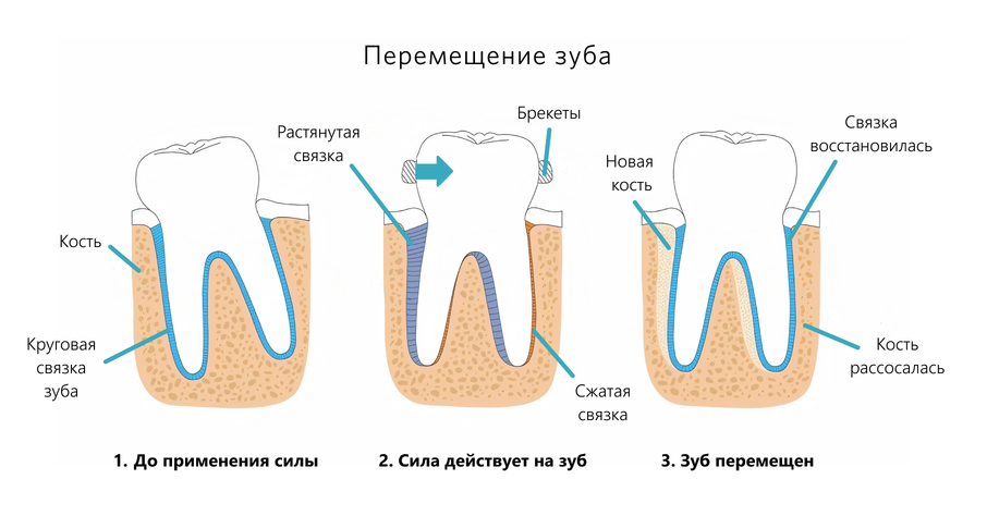 Процесс перемещения зубов брекетами