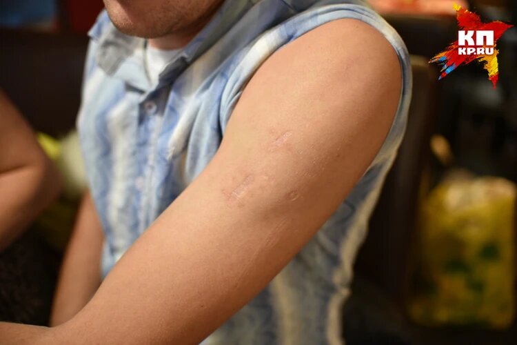 Шрамы от "любви". Фото: Влад Комяков