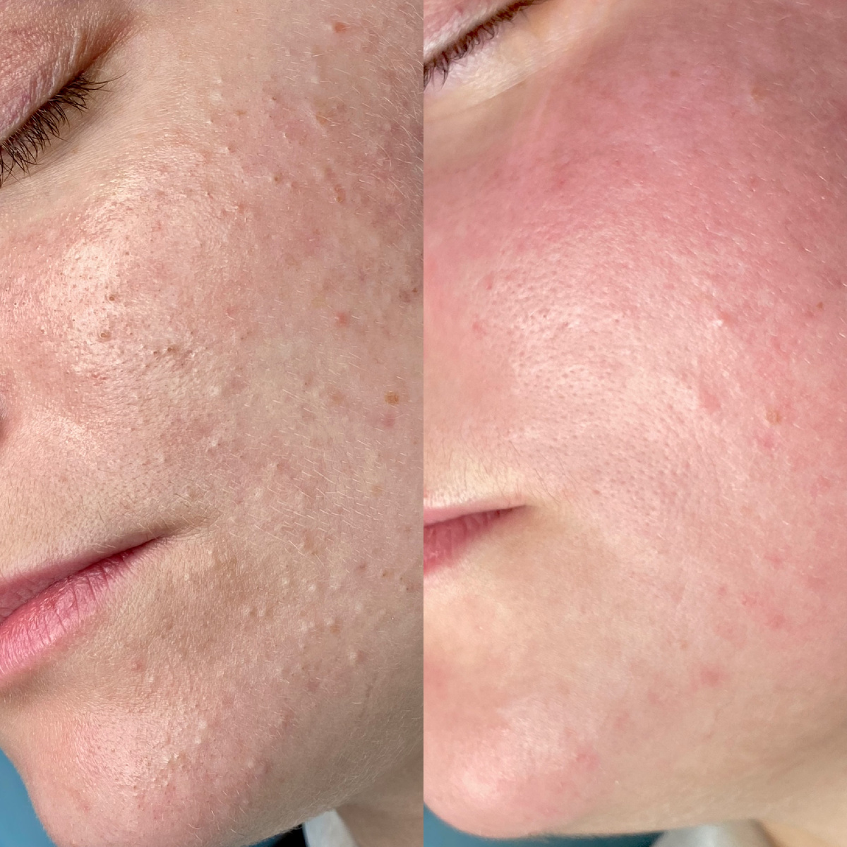 Результат нашей фирменной глубокой комбинированной чистки лица 