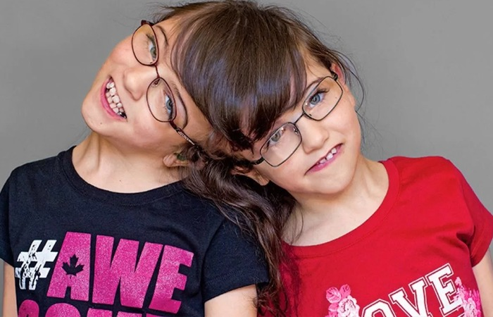 Как живут сиамские близнецы, которых не разделили: Видят глазами друг друга и ощущают общую боль