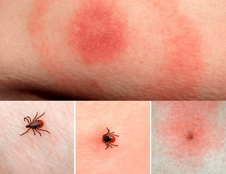 Типичные симптомы заражения боррелиями покраснения кожи в месте присасывания клеща.