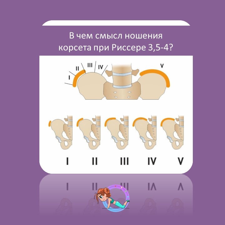 
Принято считать, что активный рост позвоночника, а значит и прогрессирование идиопатического сколиоза, происходит до достижения Риссер 3. После Риссер 4 рост практически завершен, а при Риссер 5 человек считается полностью выросшим. Поэтому корсетотерапия наиболее эффективна на ранних стадиях роста (Риссер 0-3).

Однако, стоит ли отказываться от корсета при Риссер 4⁉️

Несмотря на замедление роста, скелет еще не полностью сформирован. Корсет в этот период может помочь:

💫Скорректировать угол искривления позвоночника: Есть шанс добиться уменьшения деформации, пусть и незначительного.
💫Предотвратить дальнейшее ухудшение: Главная задача - остановить прогрессирование сколиоза.
💫Улучшить осанку и баланс тела.
💫Улучшить внешний вид.


