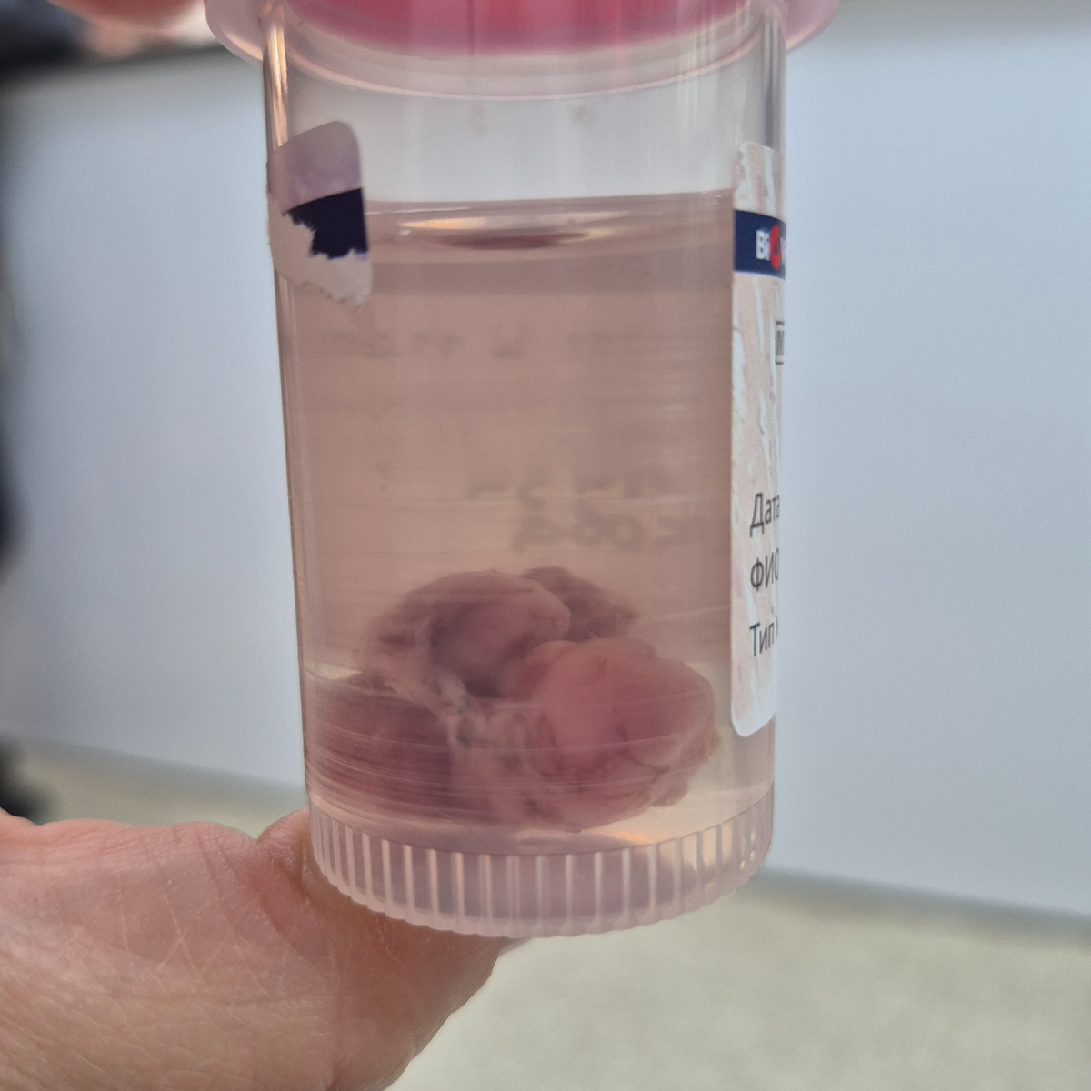 Удаленный полип, который отправляли на анализ.