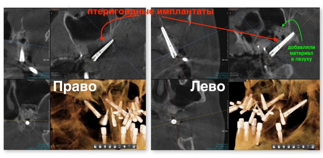 Птеригоидные имплантаты справа и слева