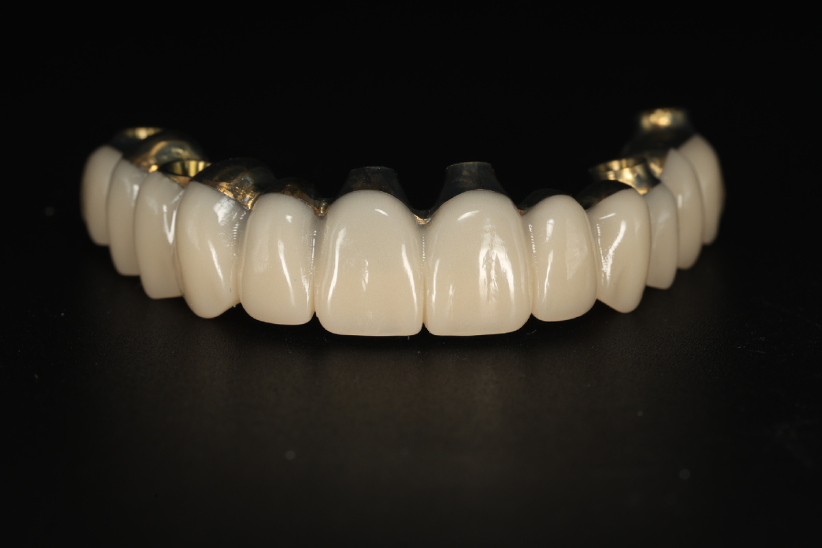 Временный адаптационный протез на титановой балке