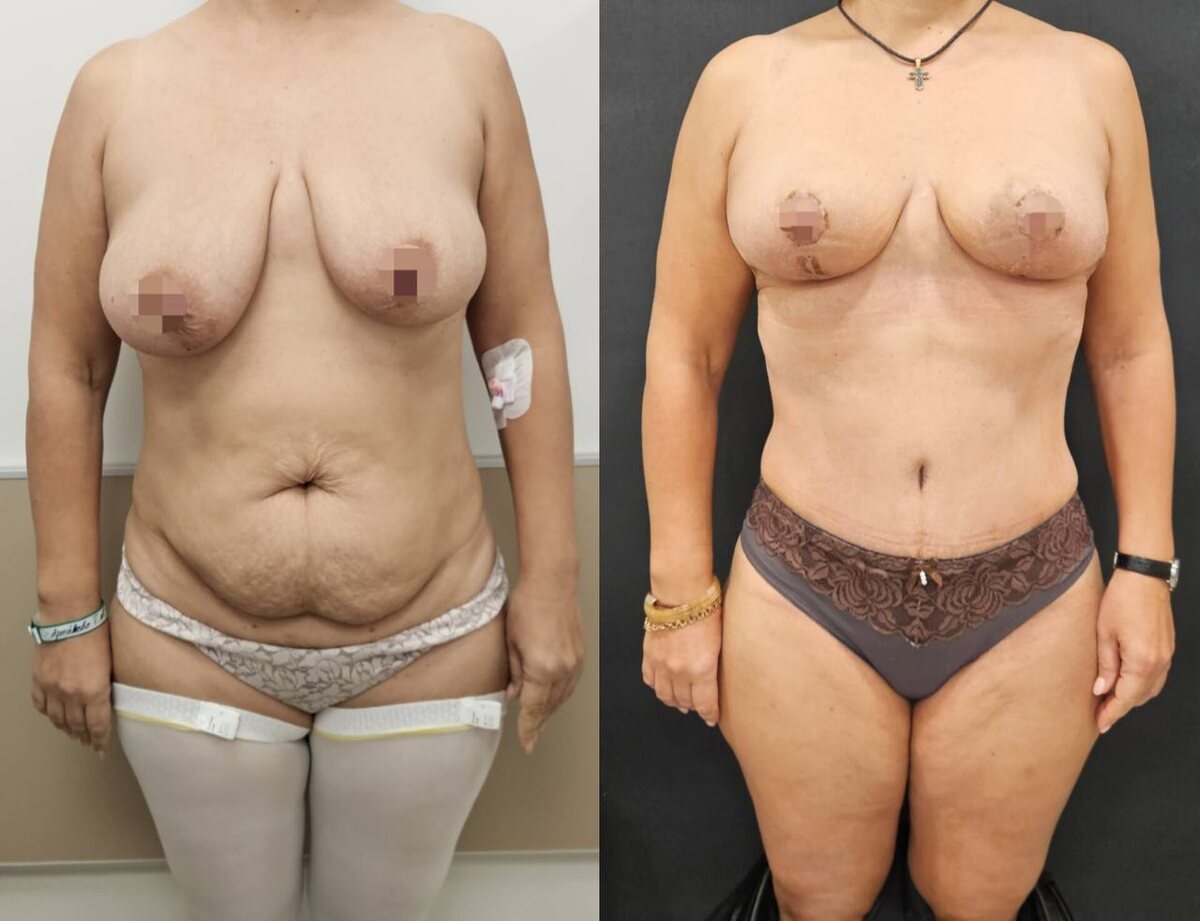 Результат абдоминопластики + подтяжка молочных желез (работа Евгения Фролова)