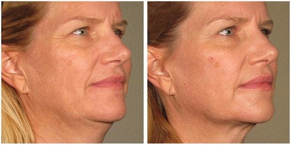 До/после RF-подтяжки у женщины 42 лет