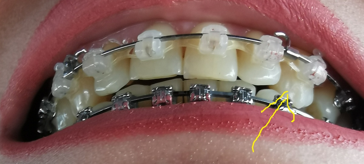 Гиперконтакт клыка