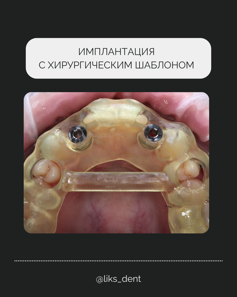 Хирургический шаблон для имплантации 