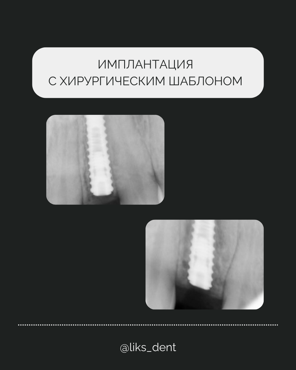 КТ-снимок с имплантами 