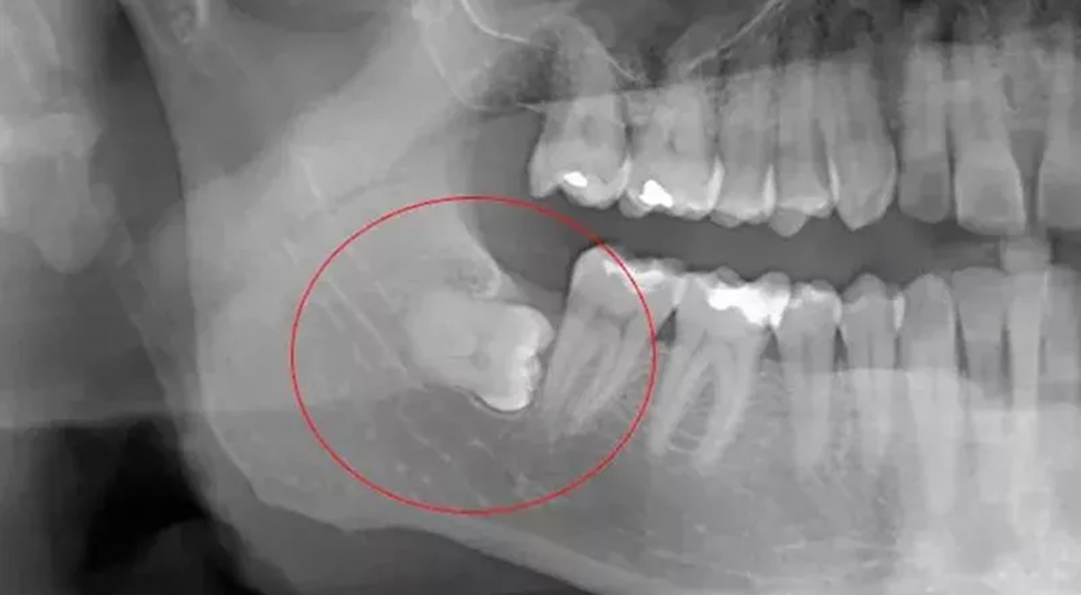 Случай с зубом мудрости.