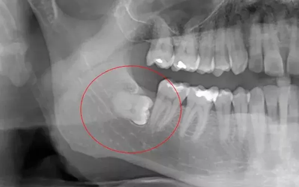 Непрорезавшийся зуб мудрости в нижней челюсти (пример рентгенограммы).
