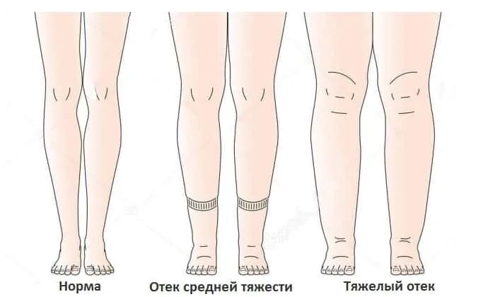 О чем говорят отеки? Психосоматика. 