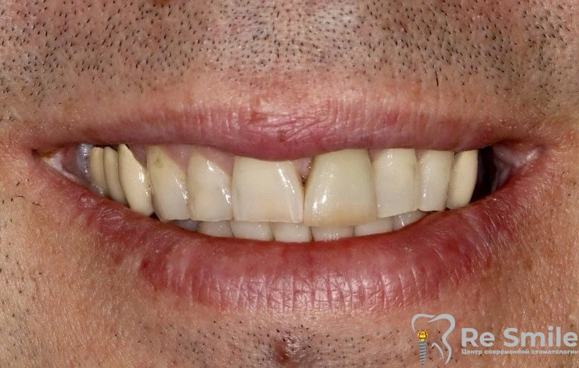 6 врачебных ошибок при установке коронок: чем может обернуться экономия на квалификации специалиста