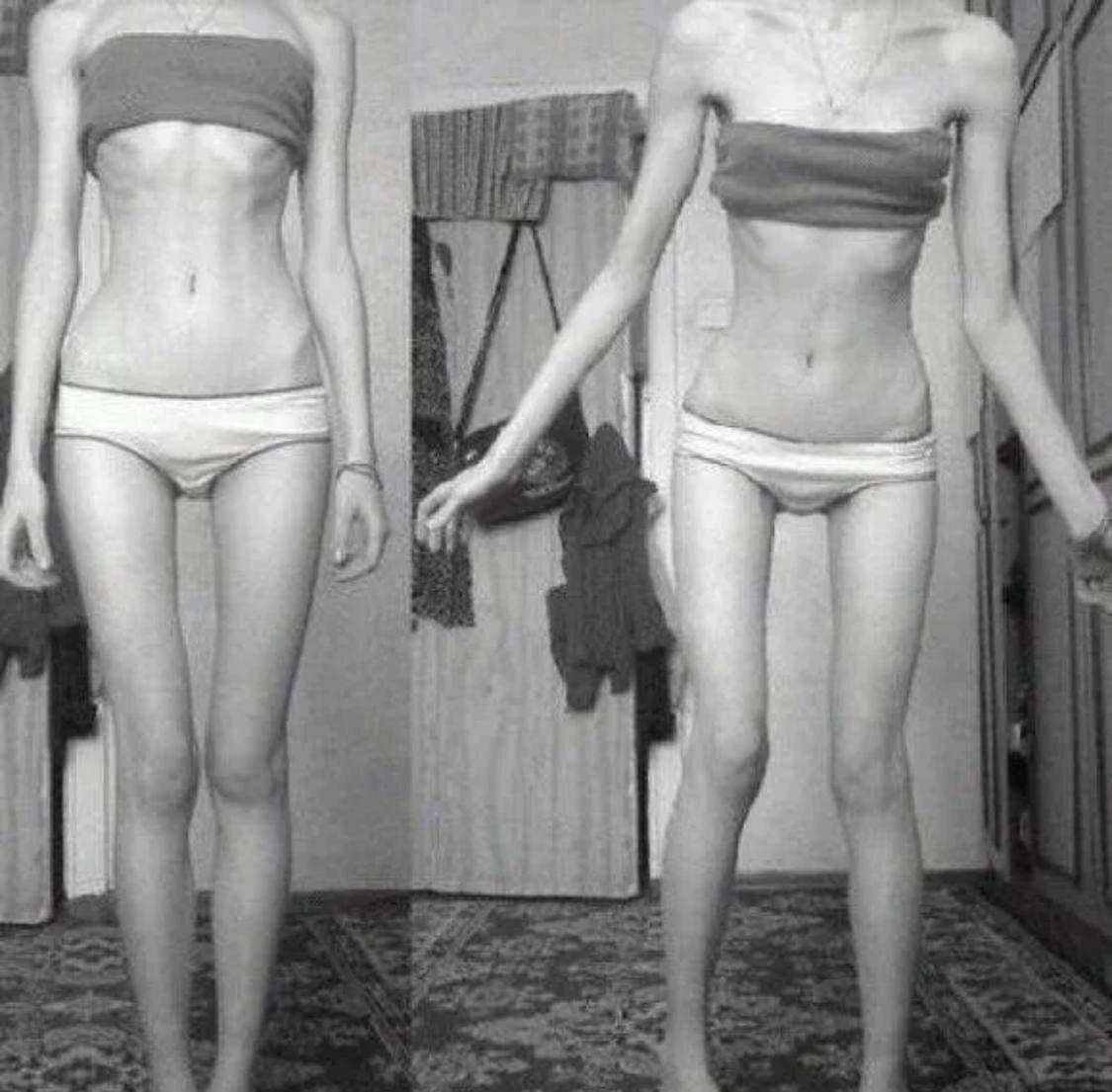 Яндекс-картинки. Нервная анорексия