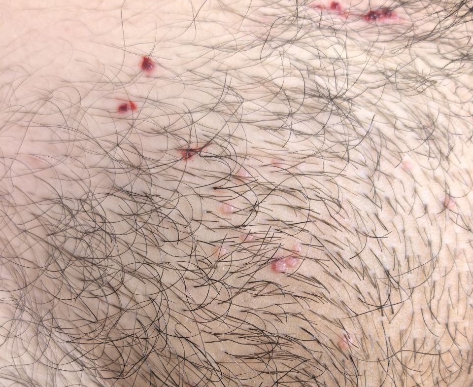 Фото контагиозного моллюска в лобковой области. Из практики Макарычева И.С.